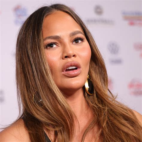 Chrissy Teigen Lowers Hairline: Shares Procedure After Bandaged Face Photo!